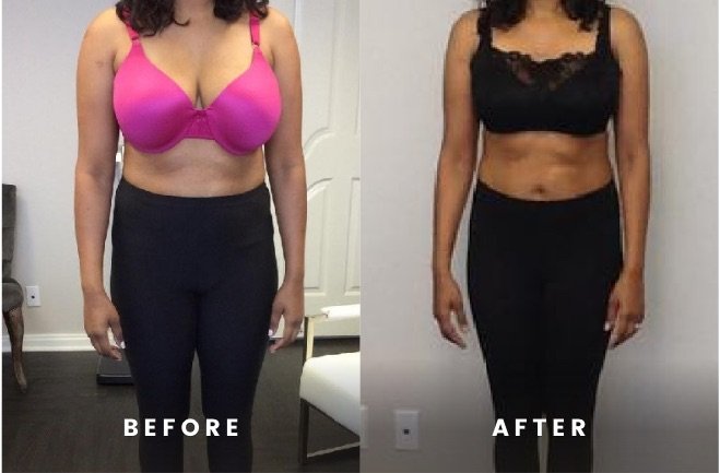 Before and After Rapid Weight Loss hCG