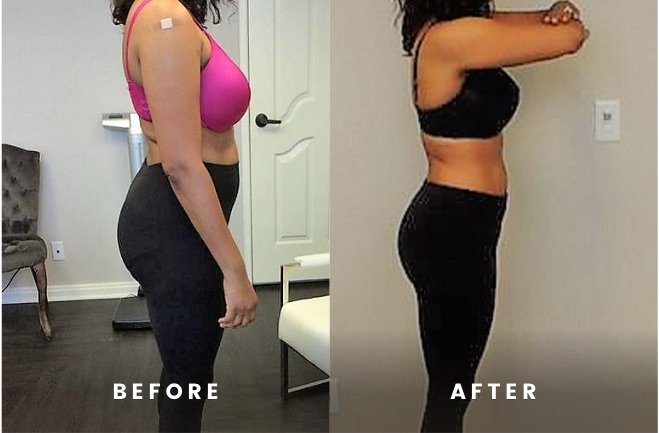 Before and After Rapid Weight Loss